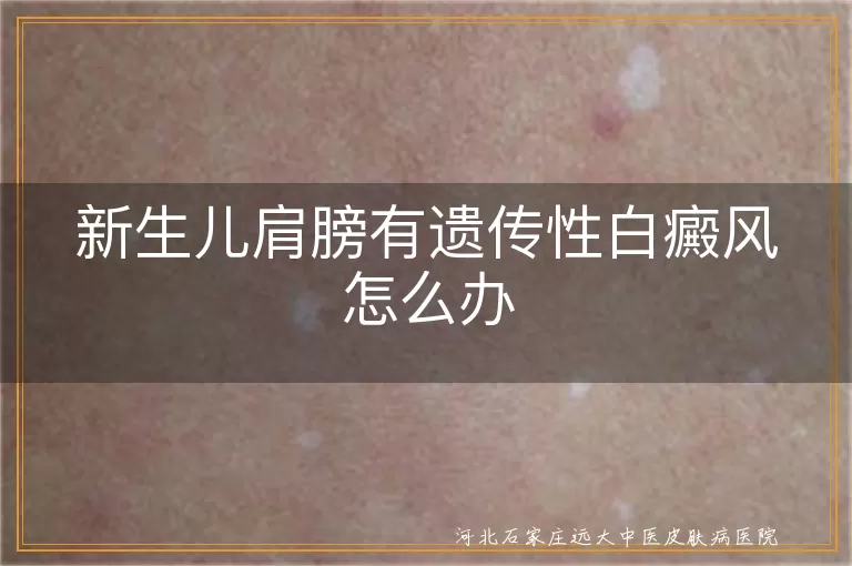 新生儿遗传性白癜风治疗方法,宝宝肩膀白斑治疗,遗传性白斑治疗选择