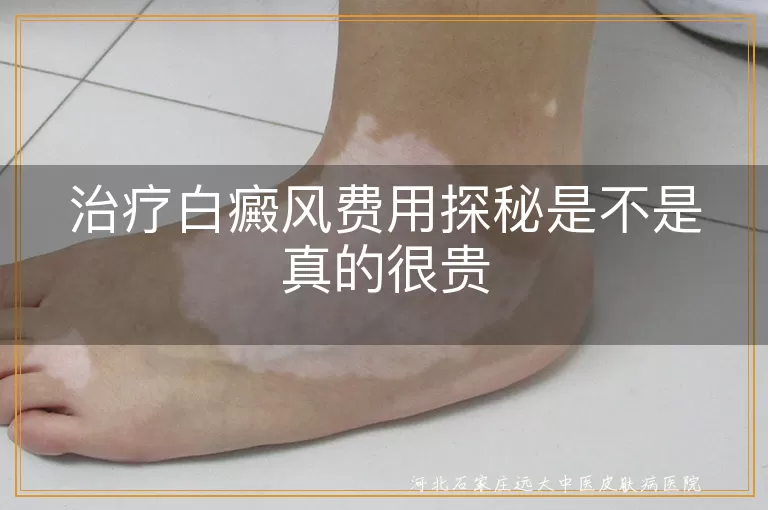 白癜风治疗费用构成,白癜风治疗贵不贵,如何降低白癜风治疗费
