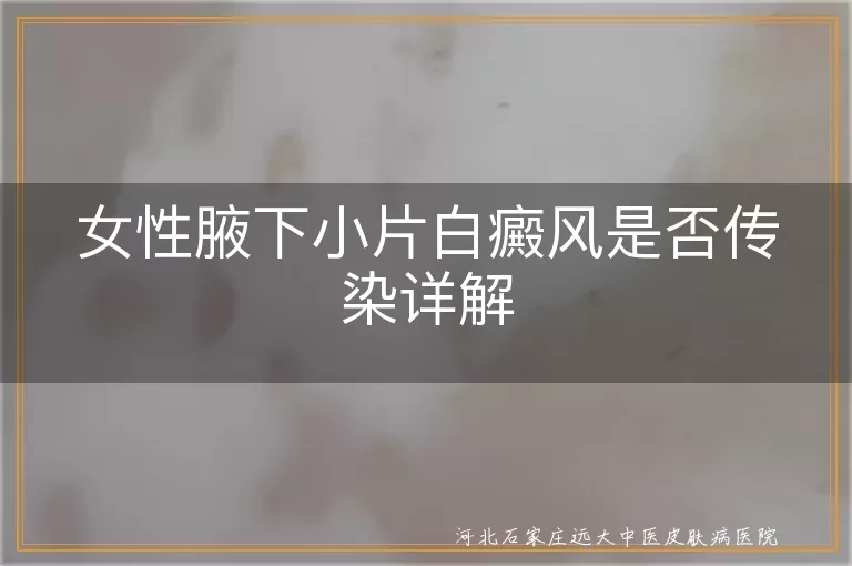 女性白癜风传染性,腋下白斑治疗,白癜风遗传倾向