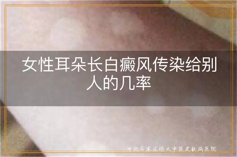 白癜风不传染给任何人, 白斑非传染病无需担忧, 女性患白癜风无传染风险