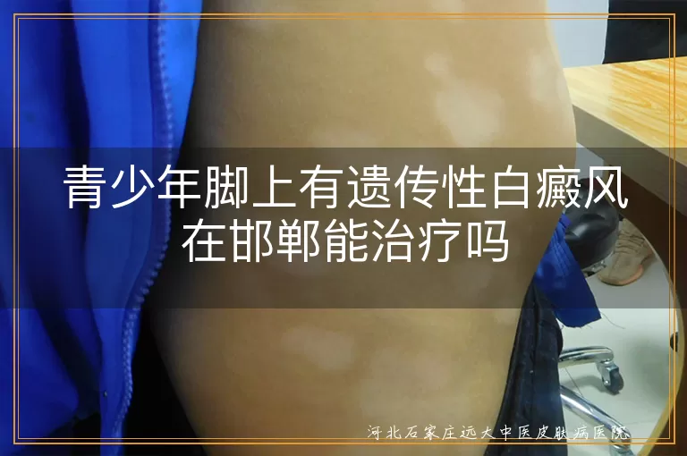 邯郸白癜风治疗医院,青少年遗传性白斑治疗,遗传性白癜风治疗方法