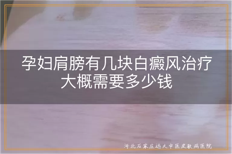 孕妇白癜风治疗费用, 孕妇肩膀白斑治疗预算, 孕妇白癜风治疗大概花费