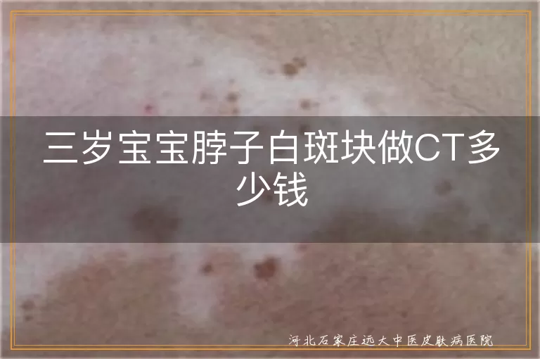 三岁宝宝脖子白斑块做CT多少钱