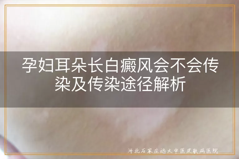 孕妇白癜风传染性,孕期白斑原因,白癜风遗传几率