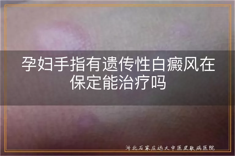 孕妇白癜风治疗方法,保定白斑病医院选择,遗传性白癜风治疗注意事项