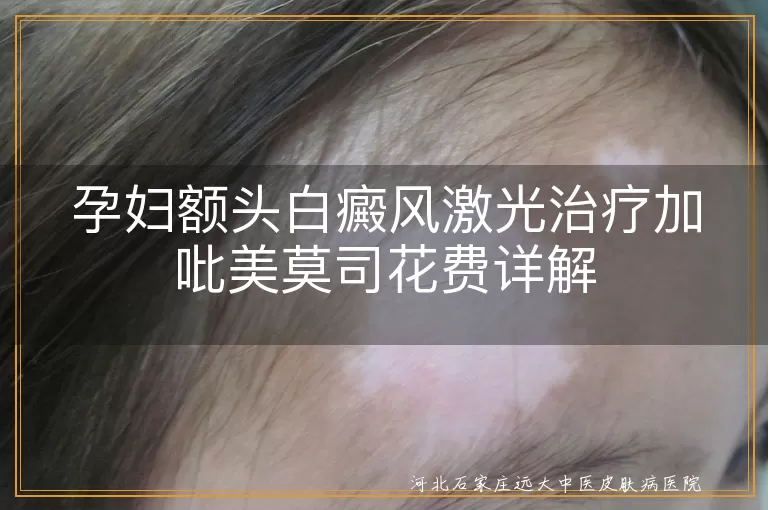 孕妇白癜风激光治疗费用,额头白斑治疗花费,白癜风药物加激光治疗成本
