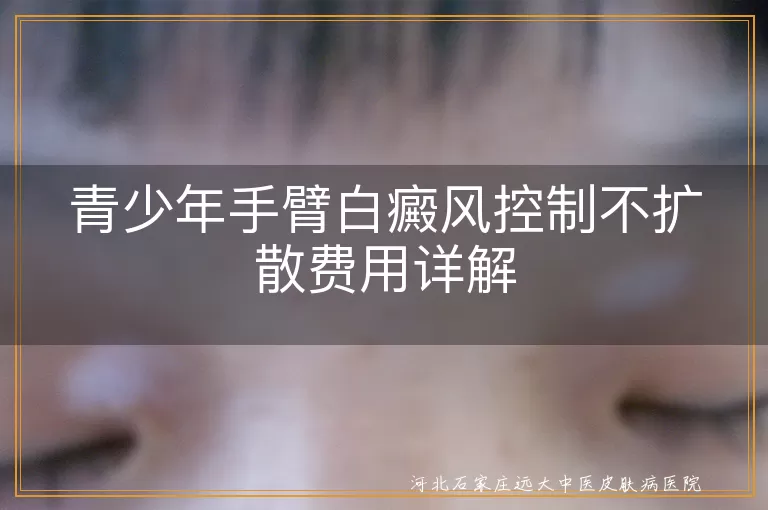 青少年手臂白癜风控制不扩散费用详解