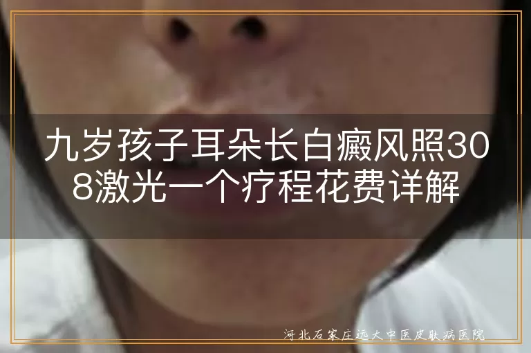 九岁孩子白癜风治疗费用, 白癜风308激光治疗花费, 九岁白斑照激光疗程费用