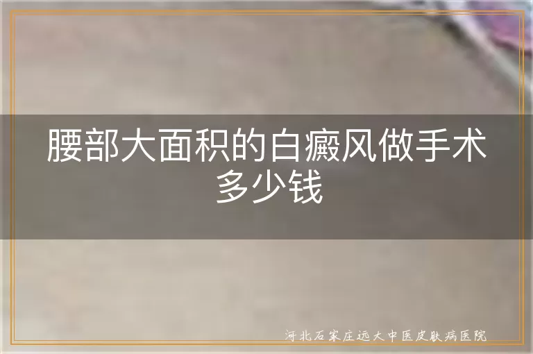 白癜风手术费用分析, 白斑治疗费用详解, 白癜风手术价格探讨