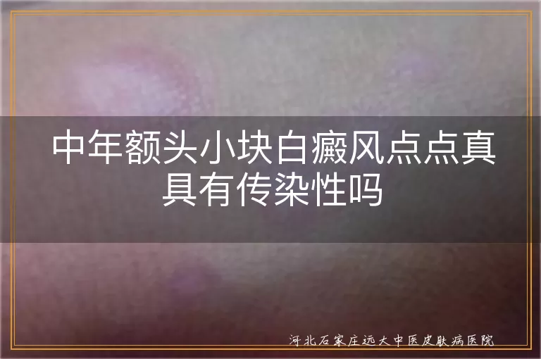 中年额头小块白癜风点点真具有传染性吗