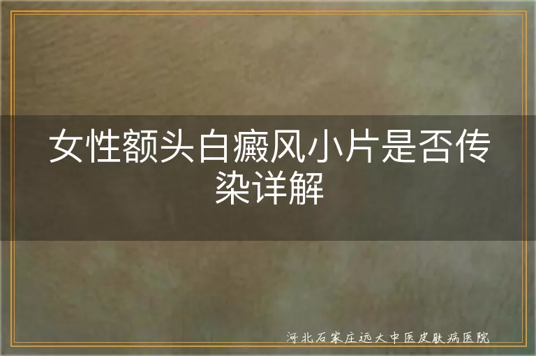 女性额头白癜风小片是否传染详解
