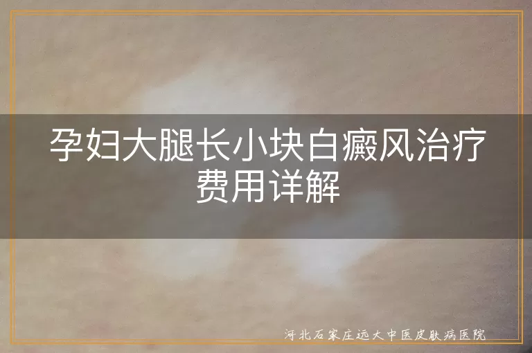 孕妇白癜风治疗费用,大腿白斑治疗成本,孕期白癜风医疗费用
