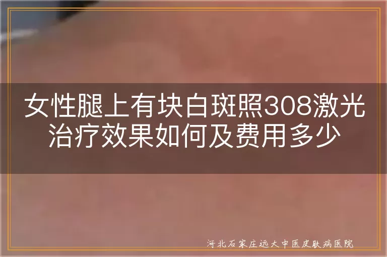 女性腿上有块白斑照308激光治疗效果如何及费用多少