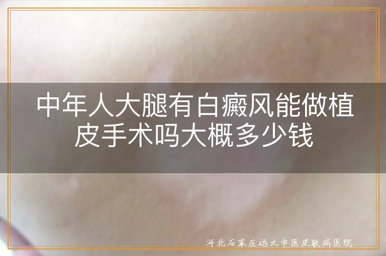 中年人白癜风植皮手术费用, 大腿白斑植皮手术多少钱, 白癜风植皮手术价格范围