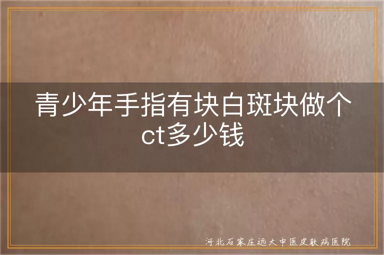 青少年手指白癜风检查费用, 白斑CT检查多少钱, 青少年手指白斑块治疗花费