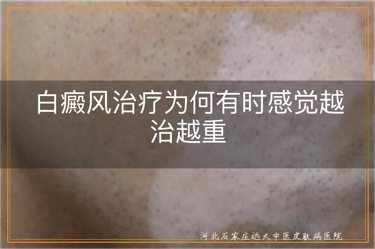 白癜风治疗为何有时感觉越治越重