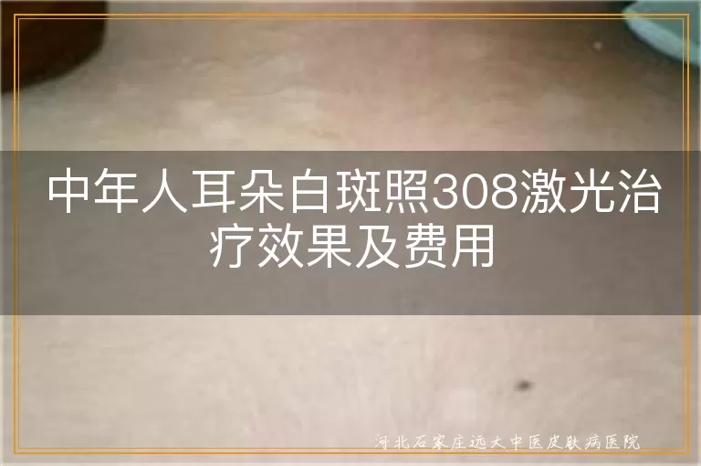 中年人耳朵白斑照308激光治疗效果及费用
