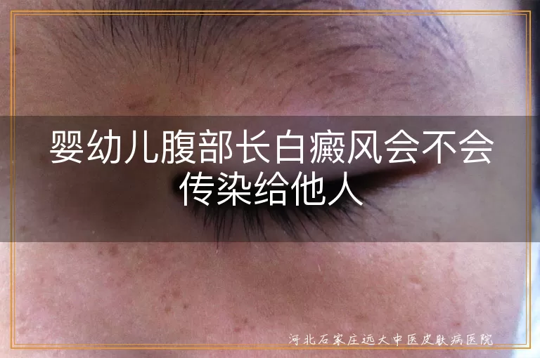婴幼儿白癜风传染性,白癜风是否会传染,婴幼儿白斑病传染问题