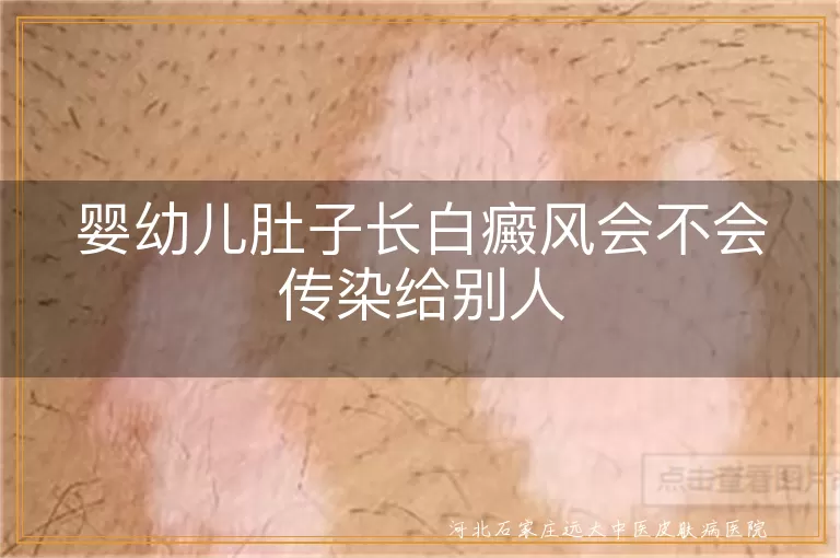 婴幼儿肚子长白癜风会不会传染给别人
