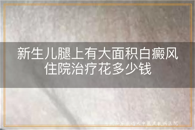 新生儿腿上有大面积白癜风住院治疗花多少钱