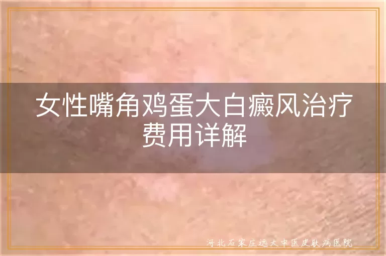 女性嘴角白癜风治疗费,白斑治疗费用因素,白癜风治愈花费