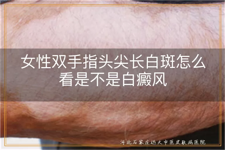 女性手指白斑鉴别要点,双手指尖白斑与白癜风关联,指尖白斑如何确诊白癜风