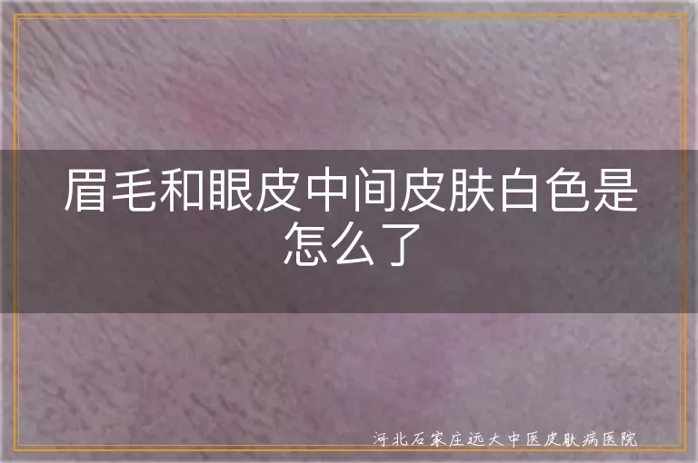 眉毛眼皮间白斑是白癜风吗,眉毛与眼皮间皮肤白斑病因,白癜风在眉毛眼皮间症状表现