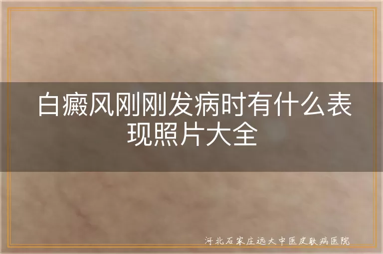 白癜风刚刚发病时有什么表现照片大全