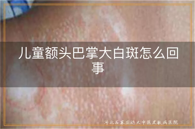 儿童额头白斑病因解析,儿童白癜风诊断与治疗,儿童额头白斑与白癜风关联