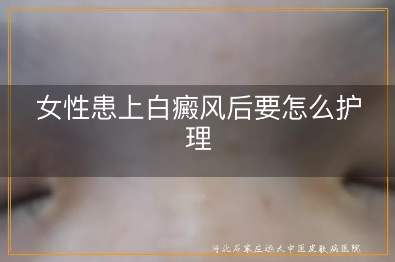 女性白癜风日常护理措施,白癜风患者皮肤保护方法,女性白斑病情管理要点