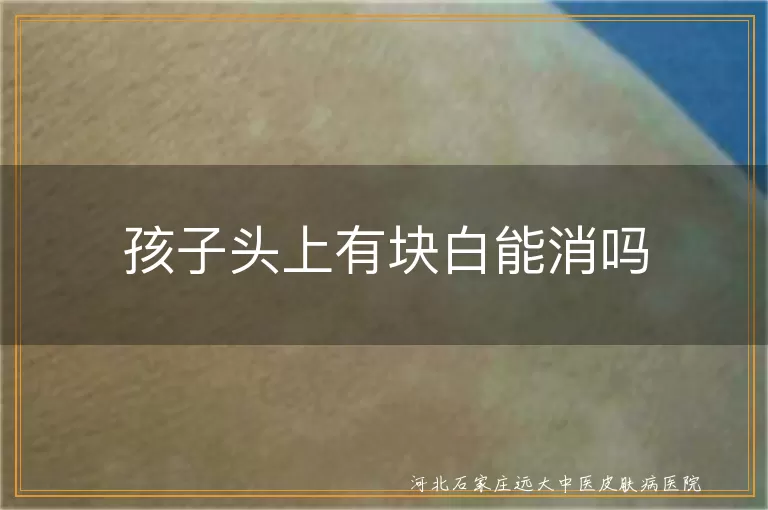 儿童头部白斑能否自愈,白癜风在儿童头部的治疗可能性,孩子头皮白斑消退方法