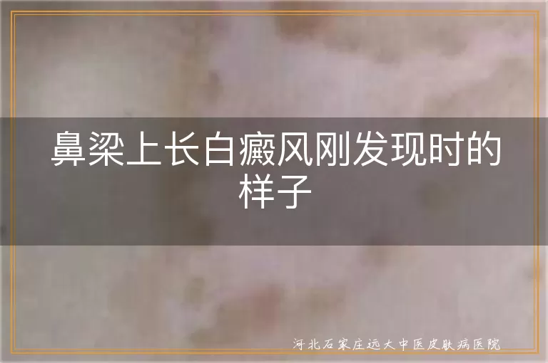 鼻梁白癜风初期形态特征,鼻梁白斑刚发现时的症状,鼻梁白癜风早期诊断依据