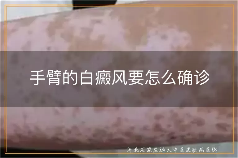 手臂的白癜风要怎么确诊