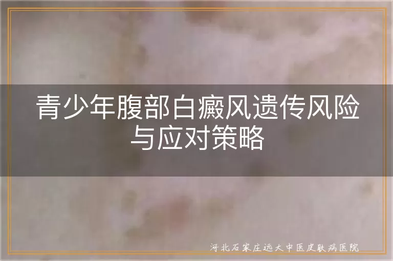 青少年腹部白癜风遗传概率,青少年白癜风治疗与预防,白癜风是否会遗传给子女