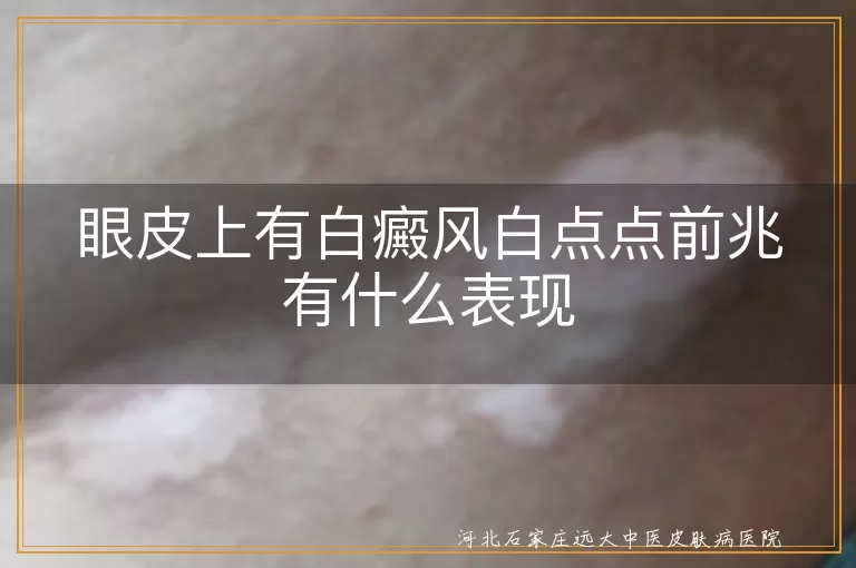 眼皮上有白癜风白点点前兆有什么表现