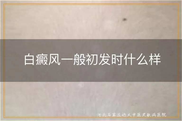 白癜风初期症状表现有哪些,白斑病初发时有哪些特征,白癜风早期皮肤有何变化