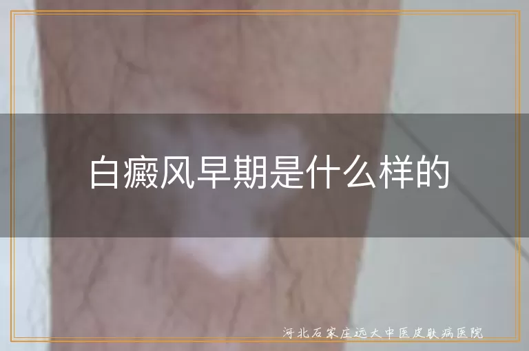 白癜风早期典型症状有哪些,皮肤出现白斑是白癜风早期吗,白癜风早期如何识别