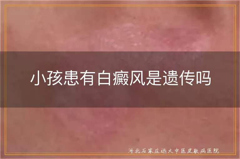 儿童白癜风遗传概率分析,儿童白斑病遗传因素探究,儿童白癜风发病原因解析
