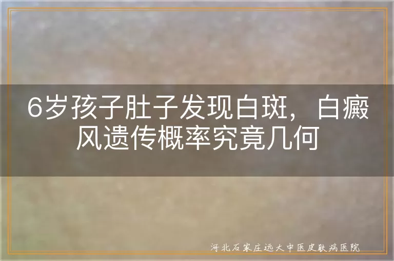 儿童白癜风遗传风险评估,6岁孩子白斑遗传概率,白癜风家族史子女发病几率