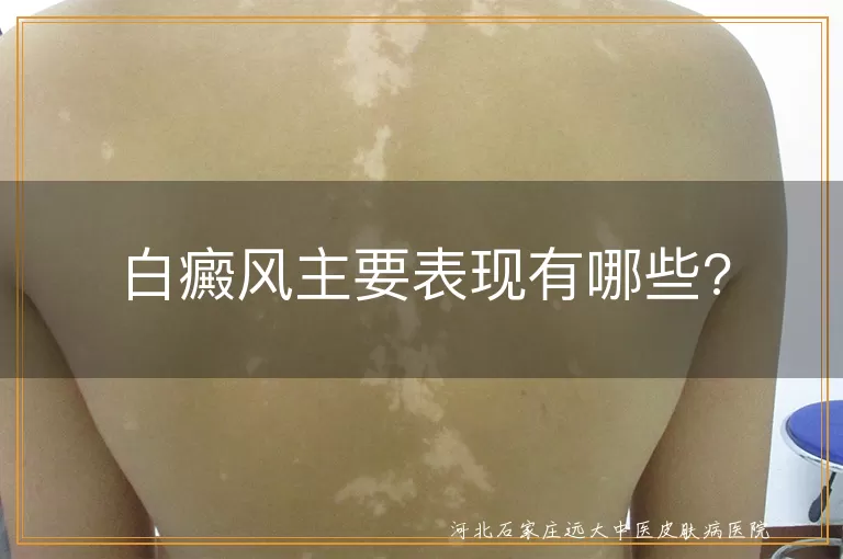 白癜风皮肤白斑特征,白斑颜色形态变化,白癜风毛发变白表现