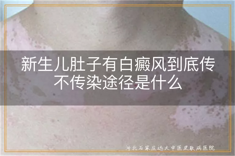 新生儿肚子有白癜风到底传不传染途径是什么
