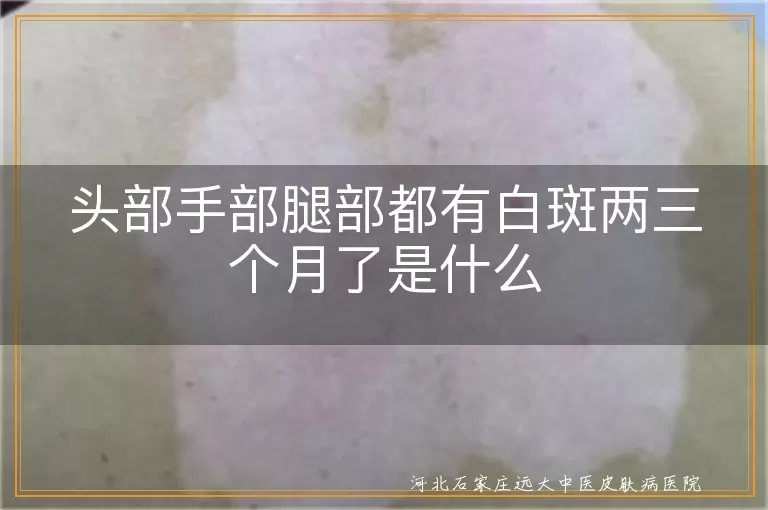 头部白斑持续三个月病因,手部腿部出现白斑可能疾病,白癜风多部位发病鉴别
