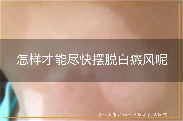 白癜风快速康复方法有哪些,皮肤白斑综合治疗手段,白癜风个性化治疗方案