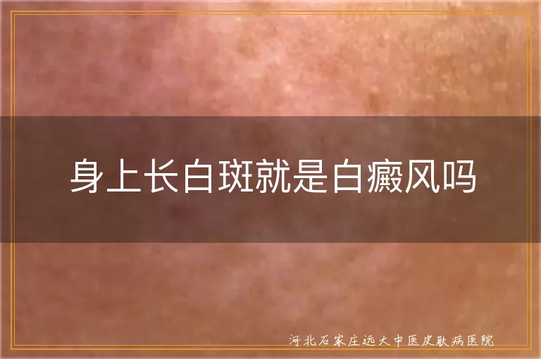 皮肤白斑的鉴别诊断方法,白癜风与其他白斑疾病的区别,白斑病因及治疗要点