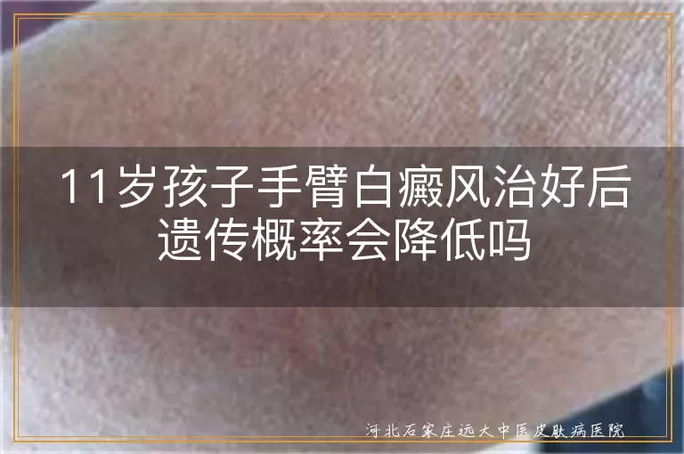 白癜风治愈后遗传风险,儿童白癜风遗传预防,白斑疾病遗传机制