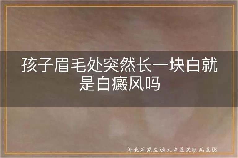 儿童眉毛处白斑鉴别要点,白癜风与其他白斑疾病区分方法,儿童白斑确诊检查项目