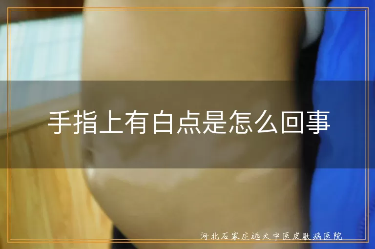 手指白斑是白癜风早期症状吗,手指白癜风初期白点表现,手指出现白斑与白癜风关联