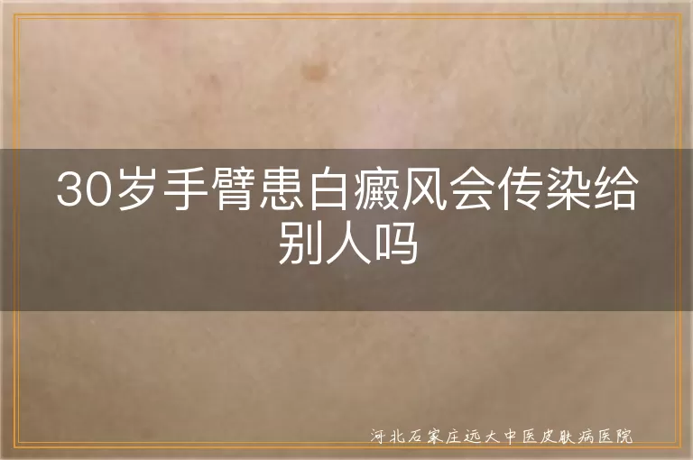 白癜风是否具有传染性,手臂白斑会传染他人吗,30岁患白癜风传染问题