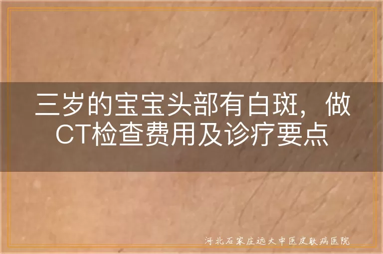 三岁儿童头部白斑检查费用,儿童白癜风CT诊断多少钱,宝宝头皮白斑做CT的价格
