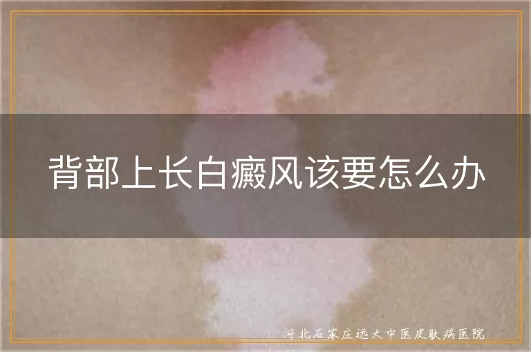 背部白癜风科学治疗方式,背部白斑日常护理建议,背部白癜风病因排查方法
